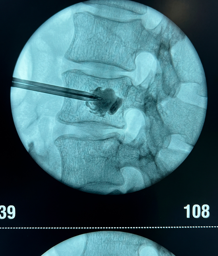 Vertebroplastia Radovan Sancevic